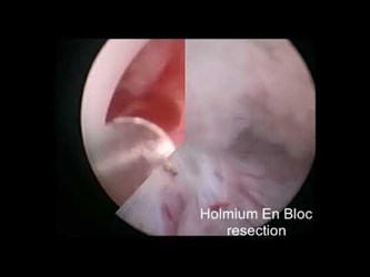 Удаление опухоли мочевого пузыря при помощи лазера